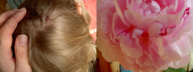 Diptych: fingers parting hair to show a small cut on a scalp, beside a close-up of a pink peony — accidents happen