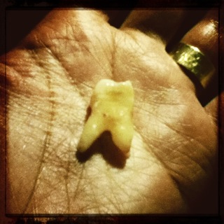 A freshly pulled molar, roots and all, lying in an open palm; a gold ring on one finger