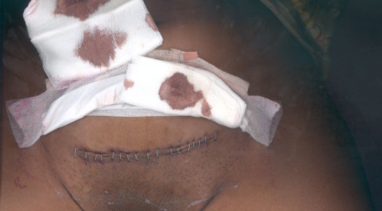 Body scan, 2002: a horizontal abdominal incision closed with a row of metal staples, stained gauze pads resting above it Body scan, 2002: a horizontal abdominal incision closed with a row of metal staples, stained gauze pads resting above it
