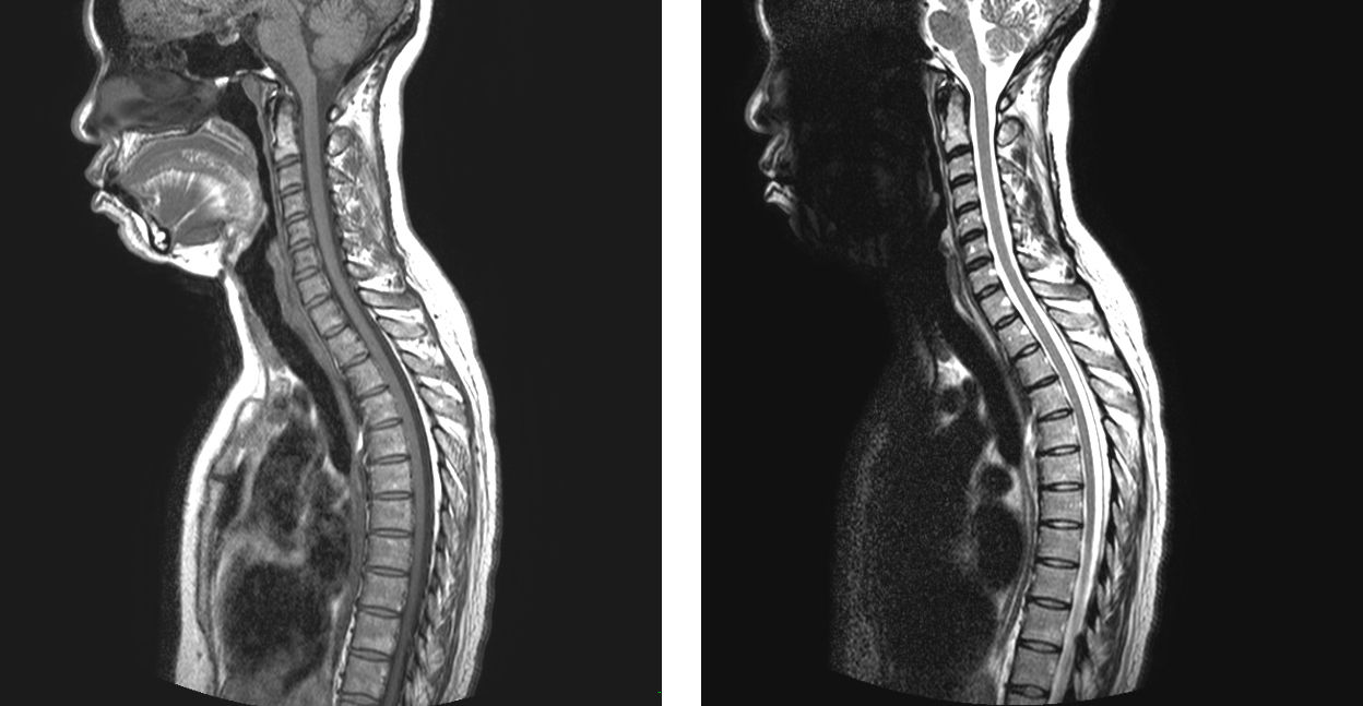 Two sagittal MRI scans of the same head and spine in profile, lips, tongue, and vertebrae glowing white against black