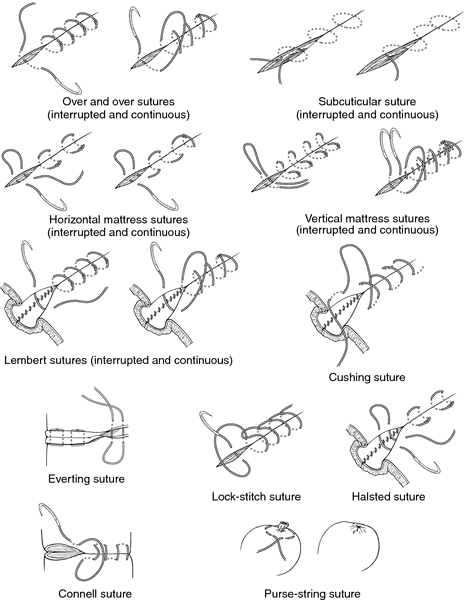 Medical diagram of suturing techniques: over-and-over, mattress, subcuticular, Lembert, Cushing, Halsted, Connell, and purse-string stitches